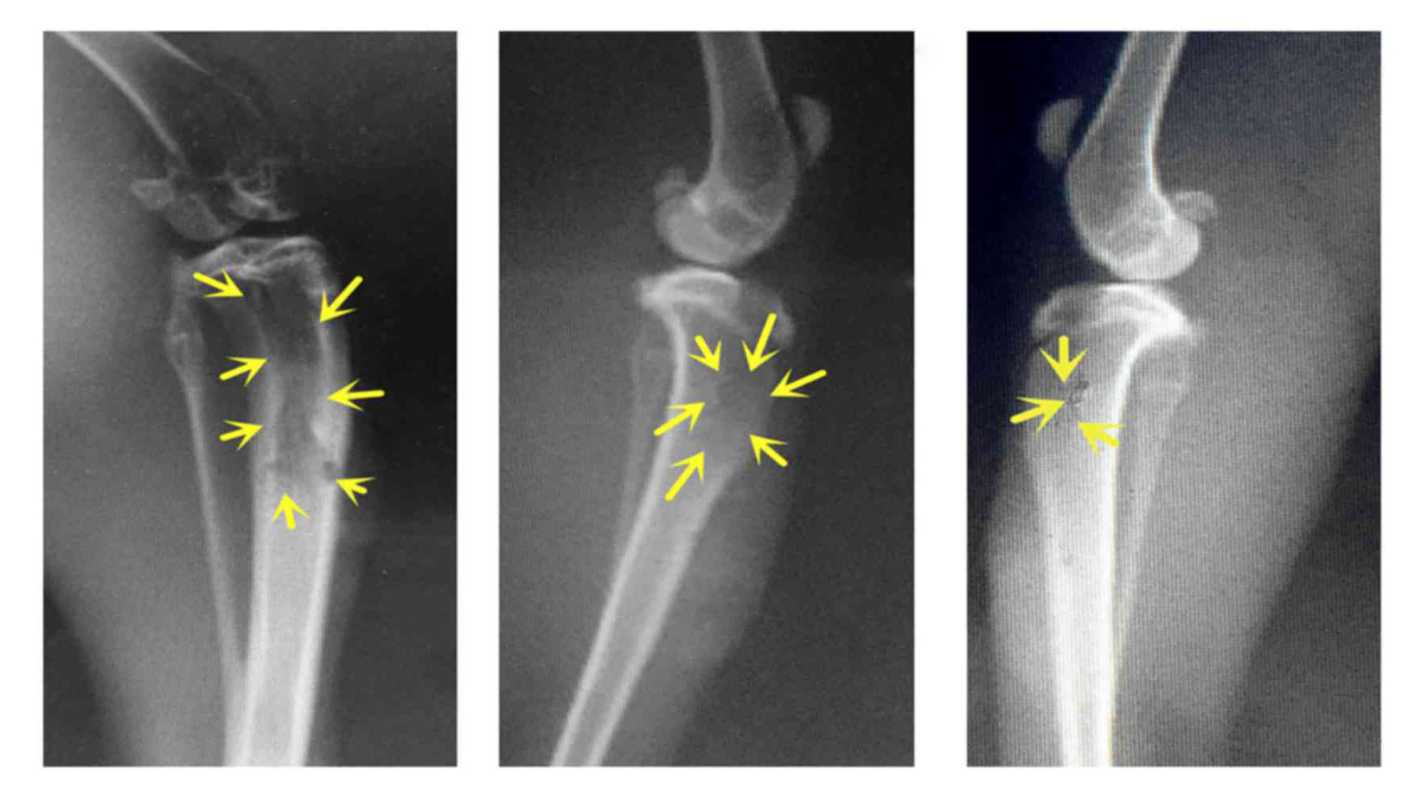 Bone Tumor